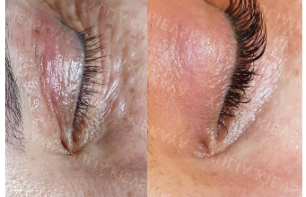 Lumi Eyes vs. Plinest Eyes: Which Treatment is Right for You?