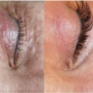 Lumi Eyes vs. Plinest Eyes: Which Treatment is Right for You?