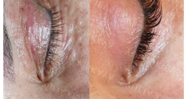 Lumi Eyes vs. Plinest Eyes: Which Treatment is Right for You?