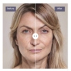 Which Filler to Choose for Anti-Wrinkle Treatment in Plymouth