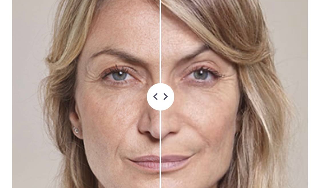 Which Filler to Choose for Anti-Wrinkle Treatment in Plymouth