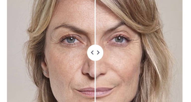 Which Filler to Choose for Anti-Wrinkle Treatment in Plymouth