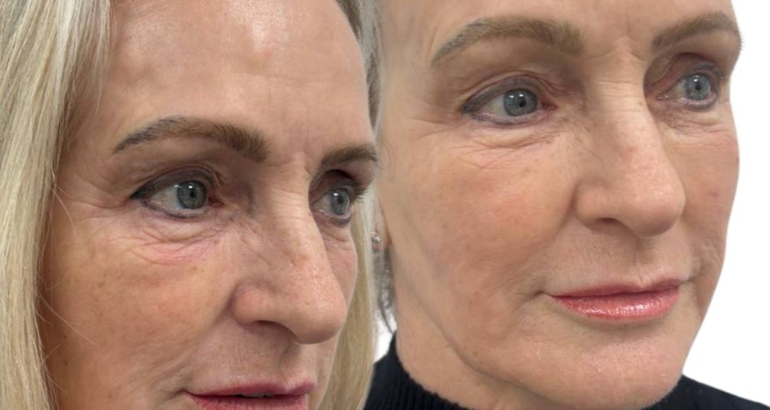 How to Get Rid of Nasolabial Folds in Plymouth