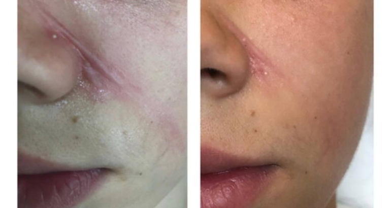 Common Skin Lesions That Require Removal