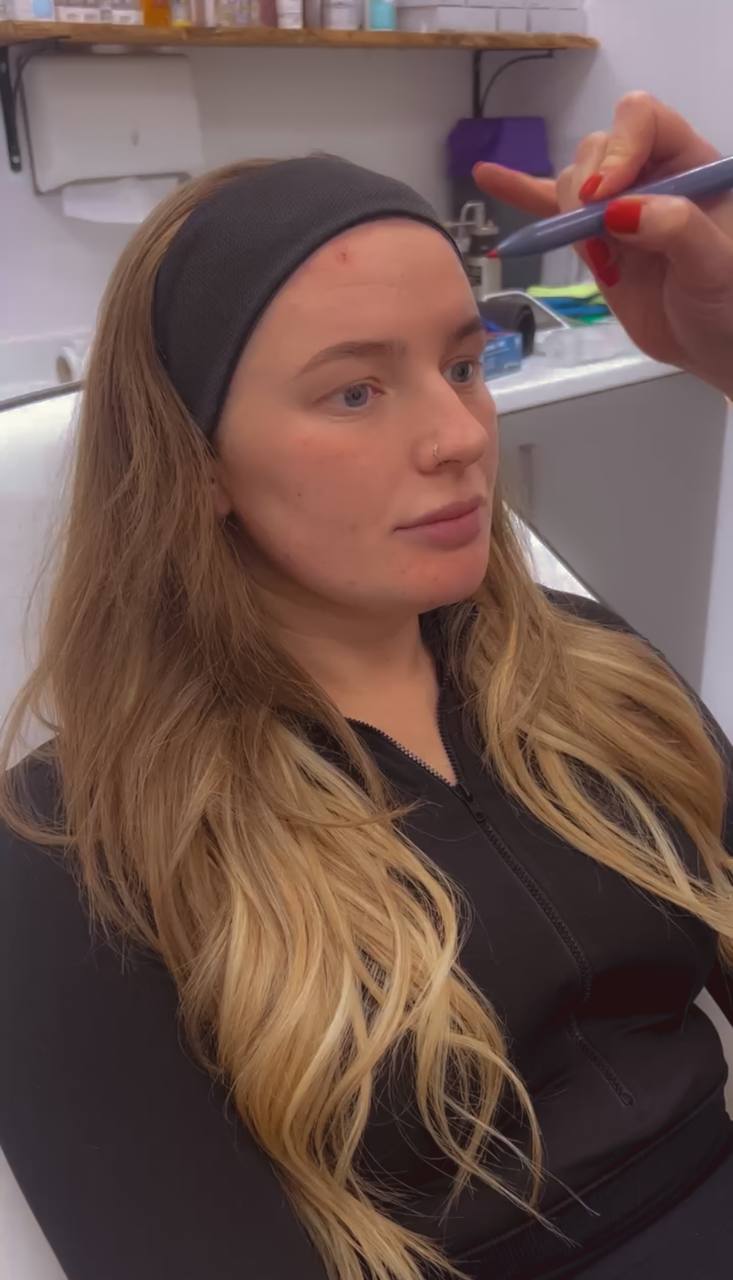 Full Face Anti-Wrinkle Treatment | Plymouth