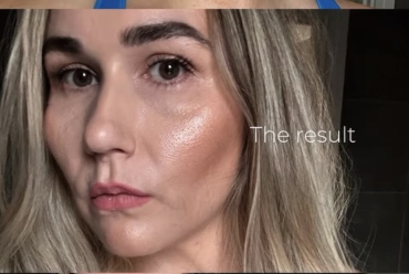 Collagen Treatments in Plymouth
