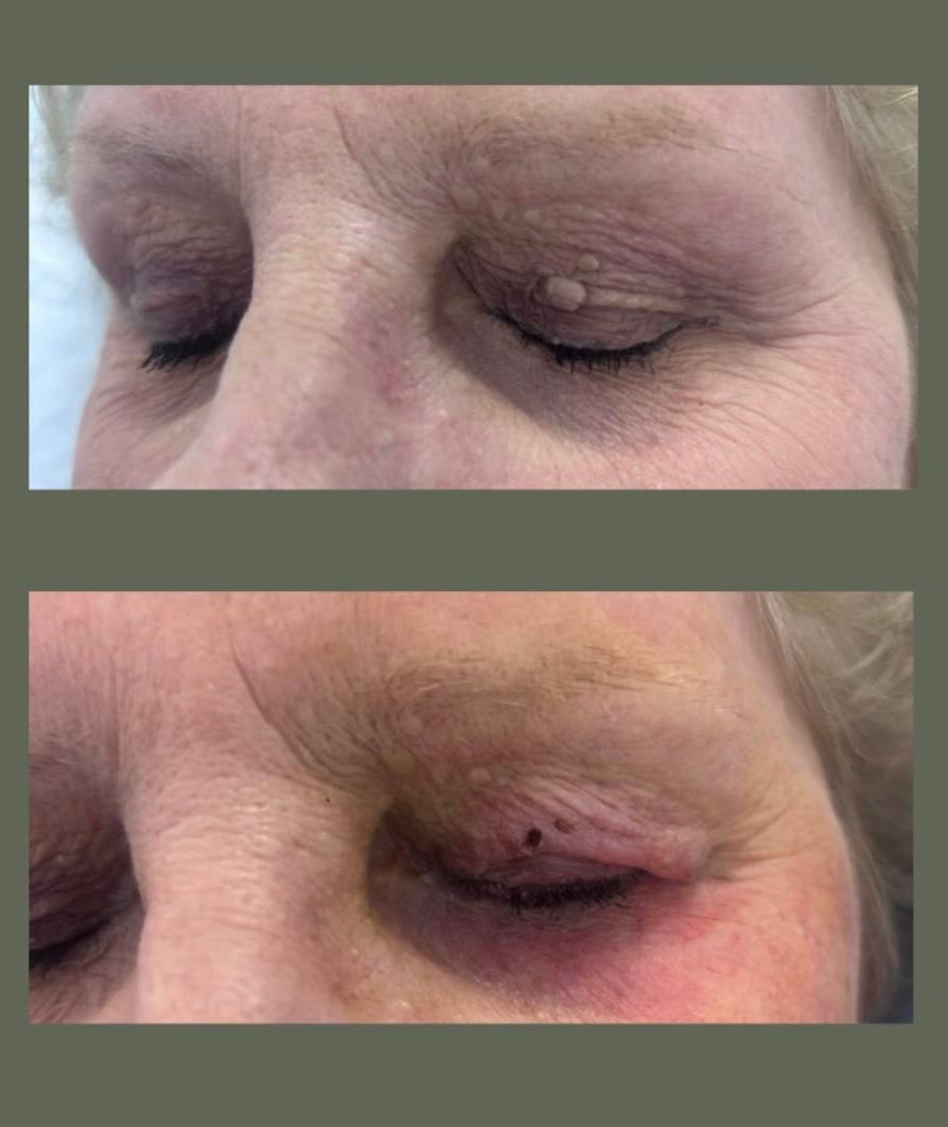 Skin Tag Removal, Mole Removal, Wart Removal in Plymouth