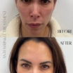 Botox in Plymouth: Smooth, Prevent, Refresh