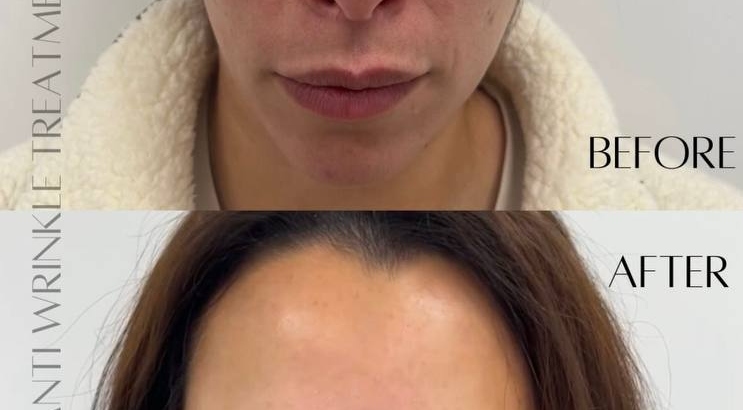 Botox in Plymouth: Smooth, Prevent, Refresh