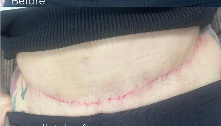 Polynucleotides & Scars in Plymouth