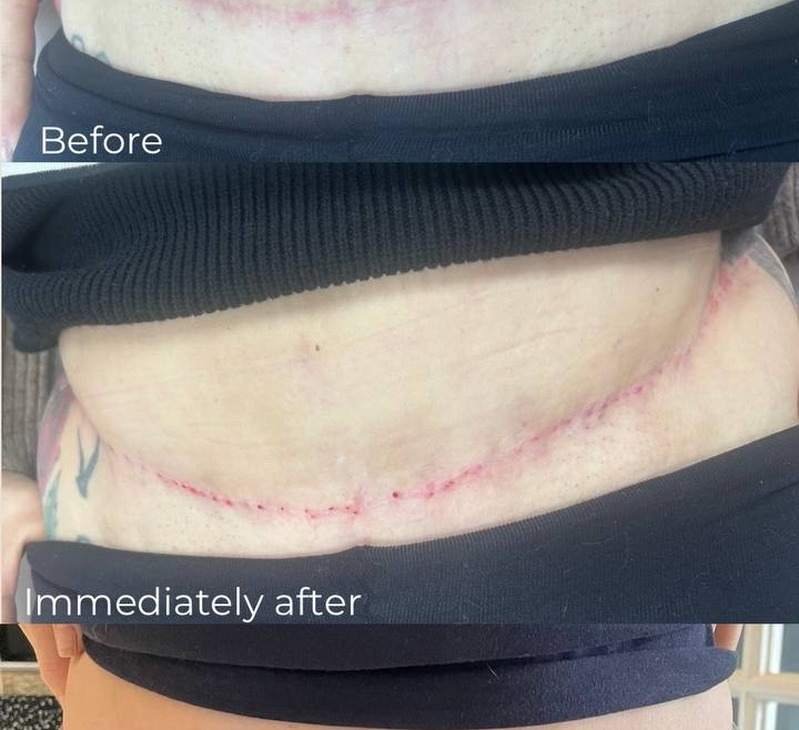 Polynucleotides & Scars in Plymouth
