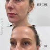 Tighten Loose Skin with Morpheus8 in Plymouth: