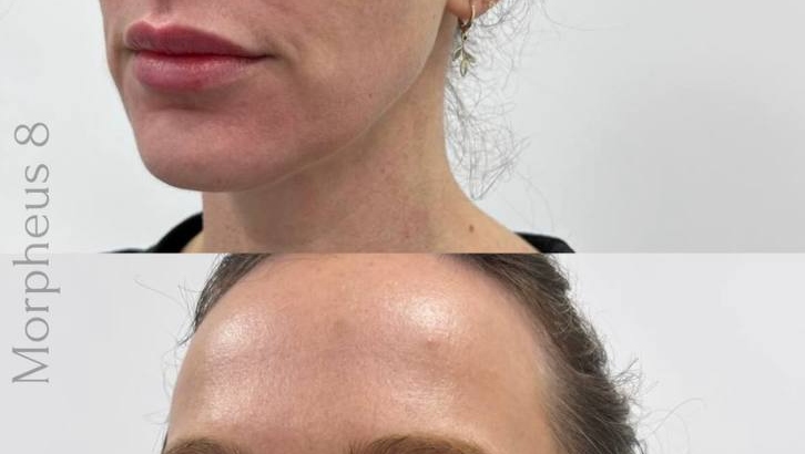 Tighten Loose Skin with Morpheus8 in Plymouth: