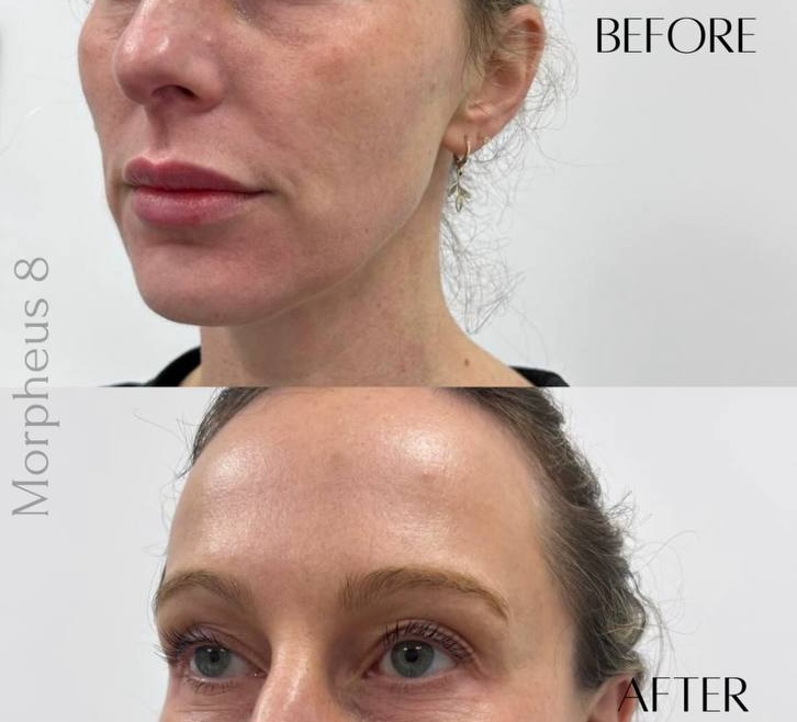 Tighten Loose Skin with Morpheus8 in Plymouth: