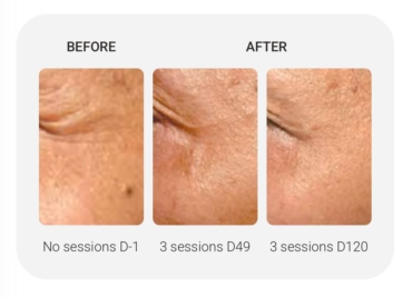 How NCTF Helps Repair Winter Skin in Plymouth