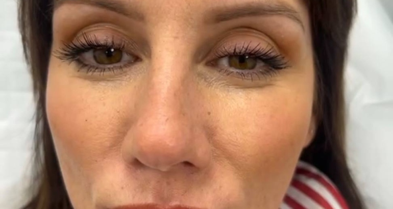 Full Face Treatment in Plymouth