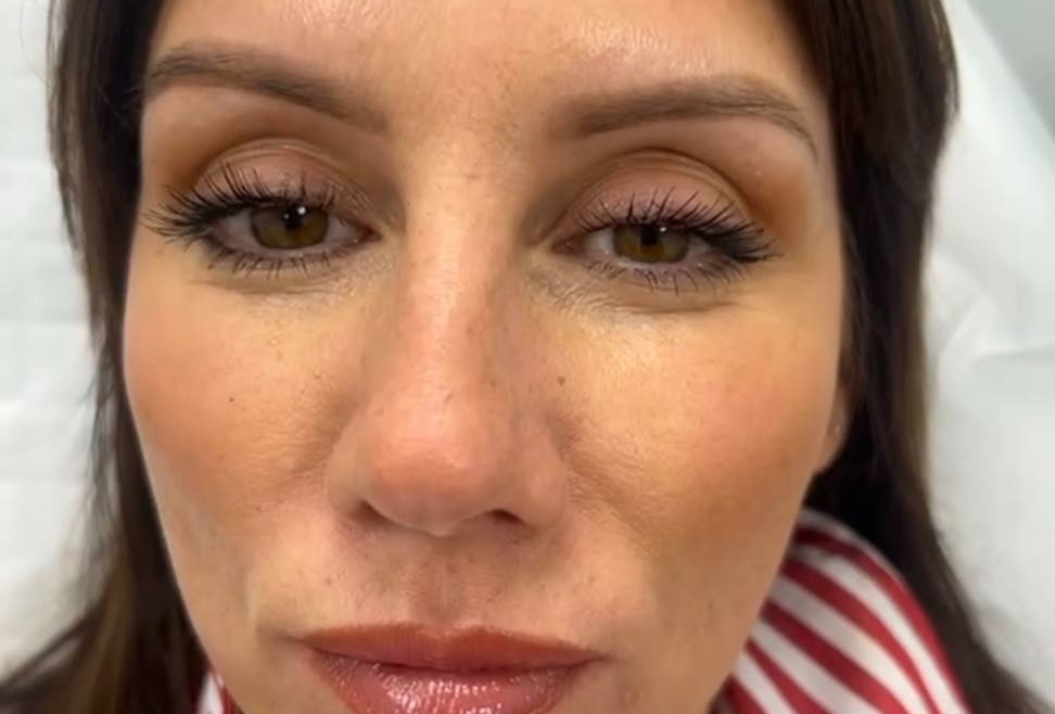 Full Face Treatment in Plymouth