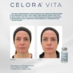 Celora™ Vita : Non-Surgical Under-Eye Rejuvenation in Plymouth