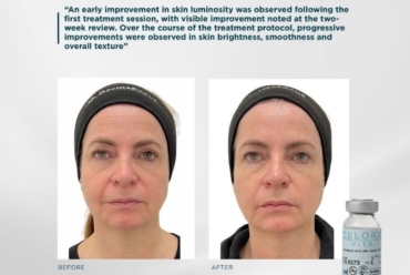 Celora™ Vita : Non-Surgical Under-Eye Rejuvenation in Plymouth