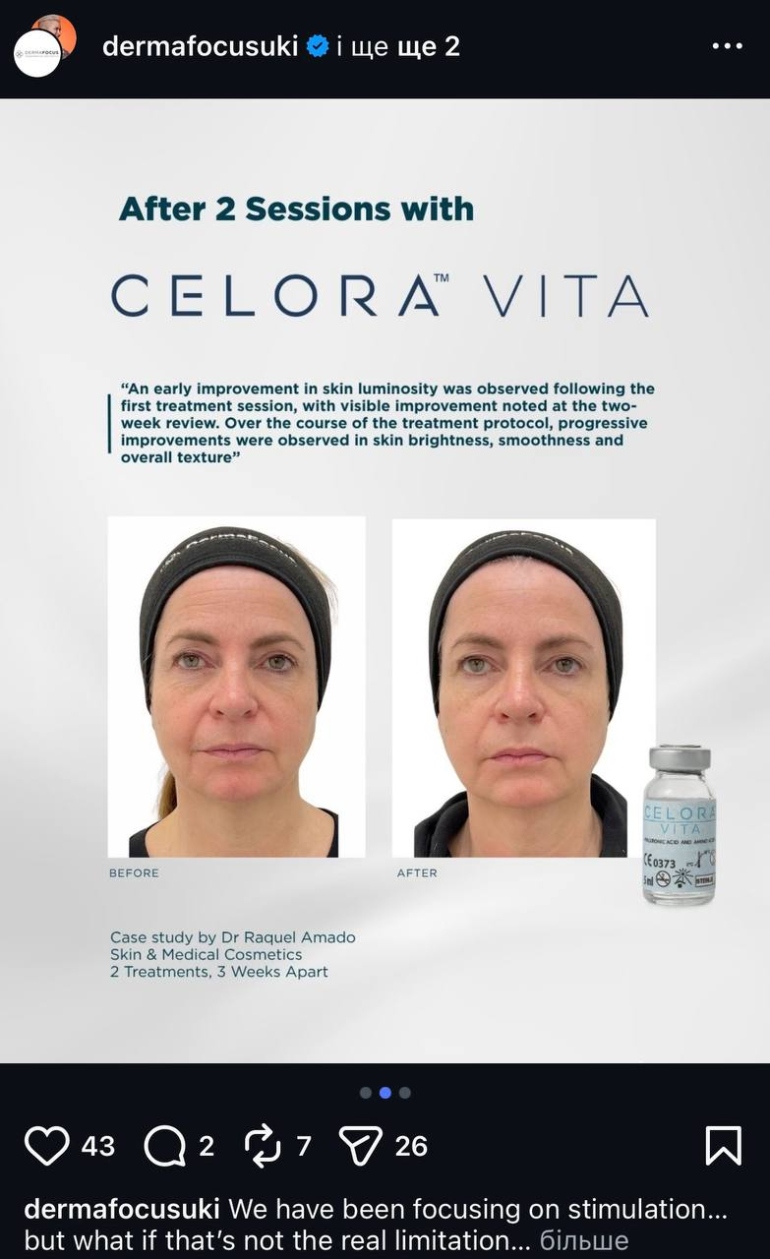 Celora™ Vita : Non-Surgical Under-Eye Rejuvenation in Plymouth