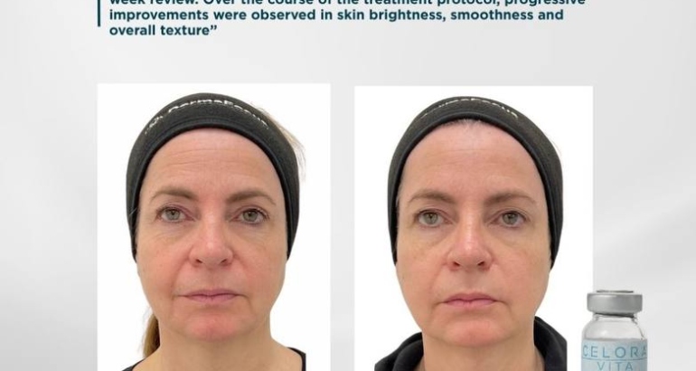 Celora™ Vita : Non-Surgical Under-Eye Rejuvenation in Plymouth