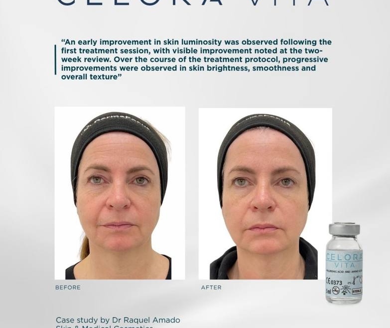 Celora™ Vita : Non-Surgical Under-Eye Rejuvenation in Plymouth